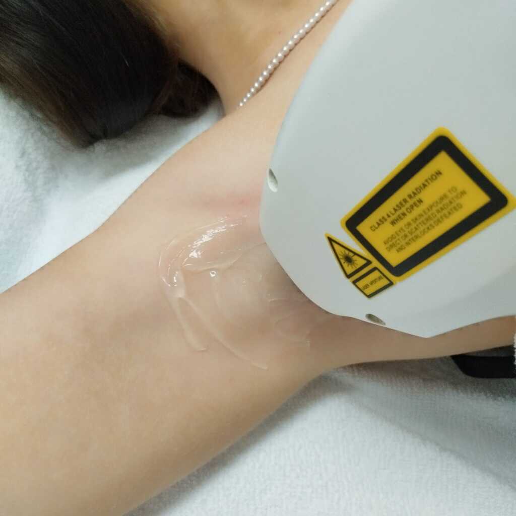 Eine behandelte Hautstelle am Arm mit einer Laserbehandlungsmaschine, die auf die Haut aufgetragen wird.